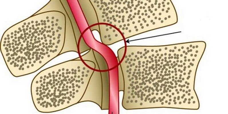 Deformación da arteria vertebral por inestabilidade vertebral